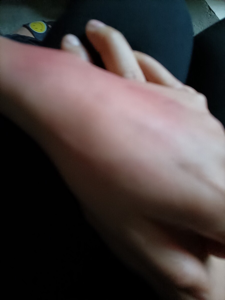 手被开水烫到,好疼.