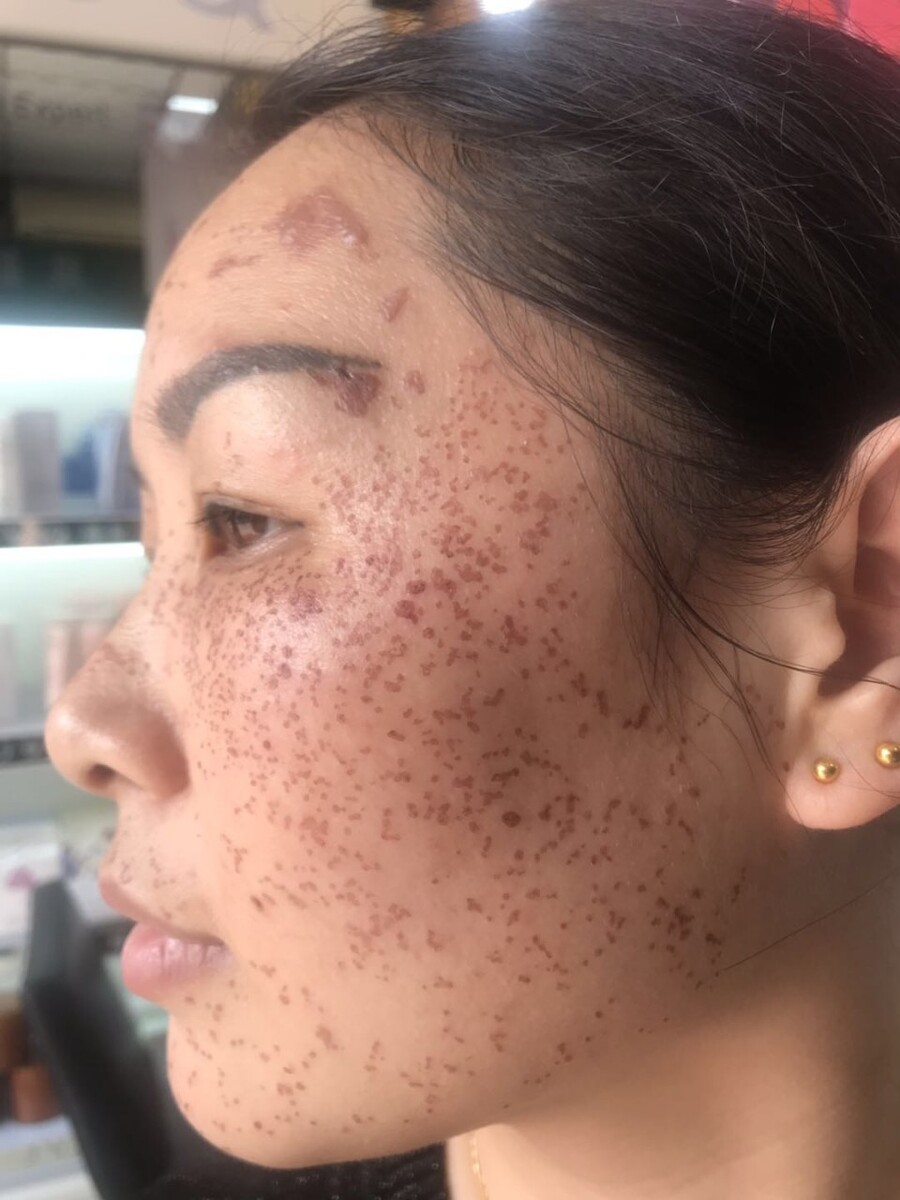 健身会长痘