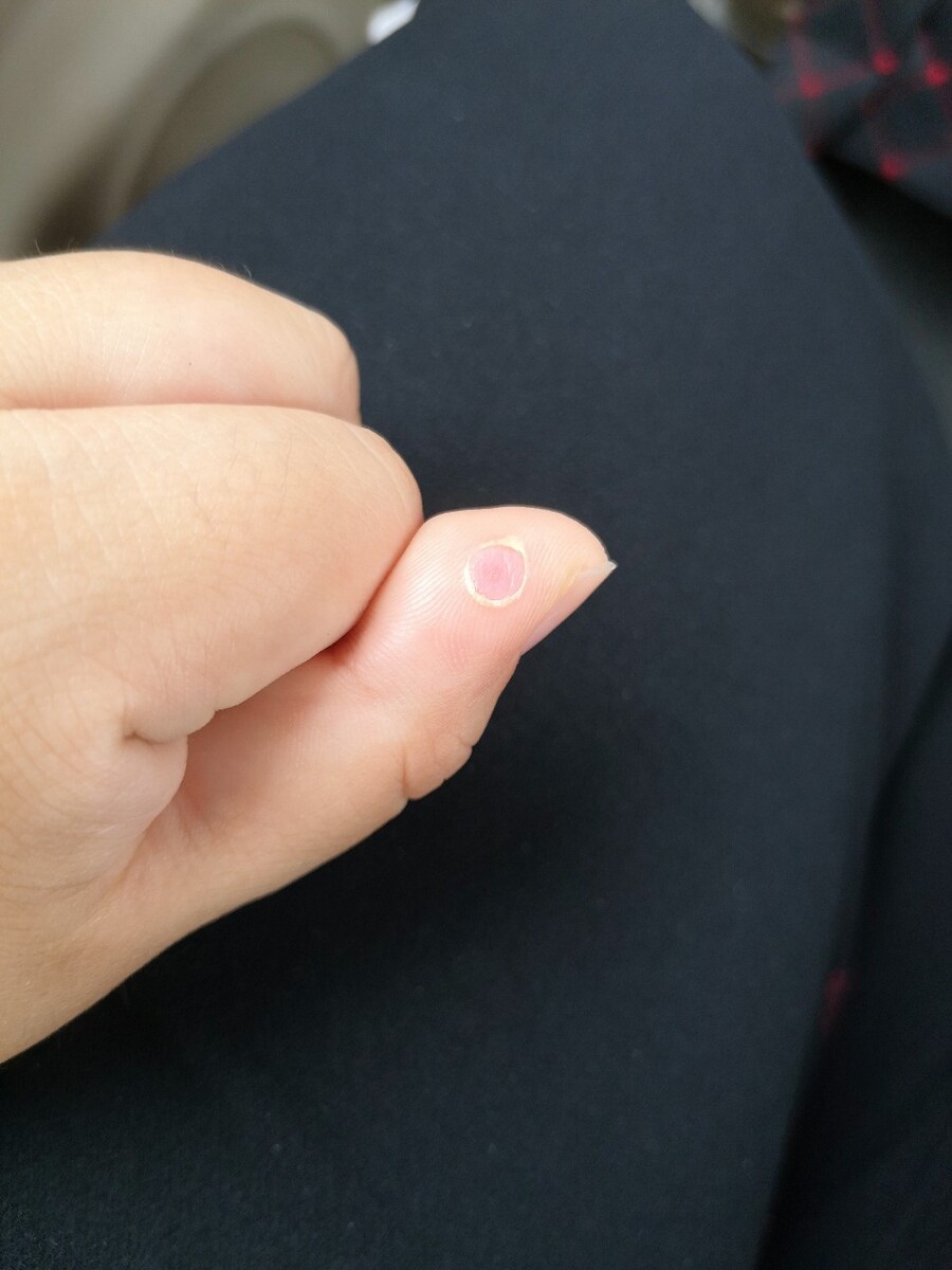 新生儿指甲线出现异常需要查验是否是指甲异常