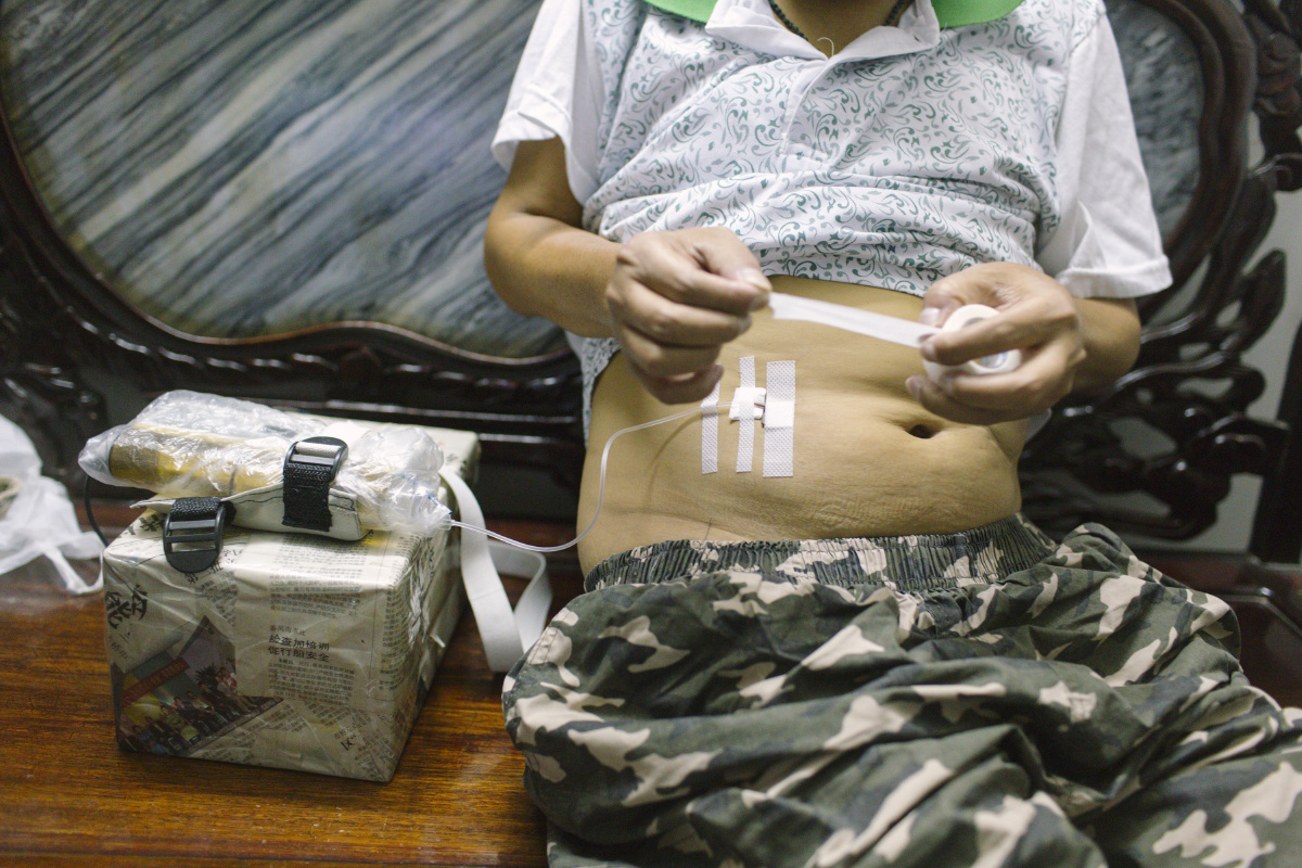 追赶扩张的地中海贫血