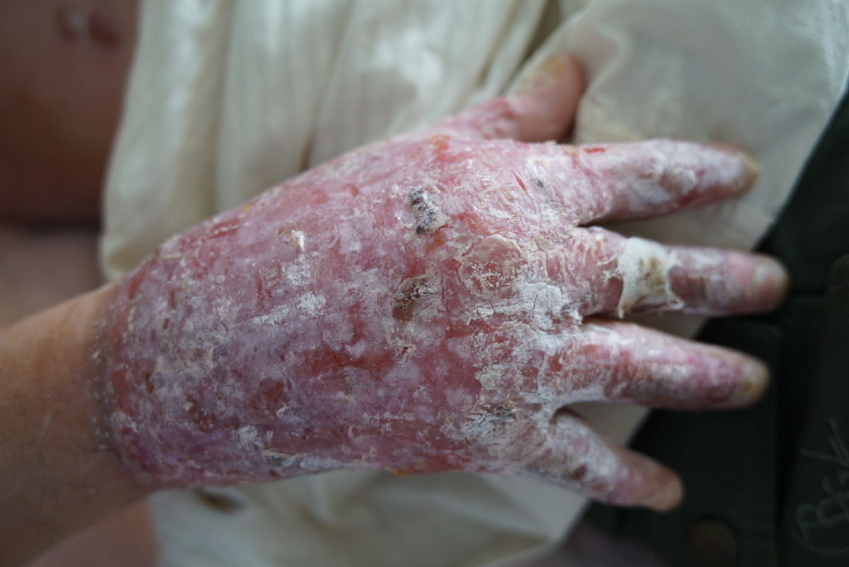 大面积烧伤患者