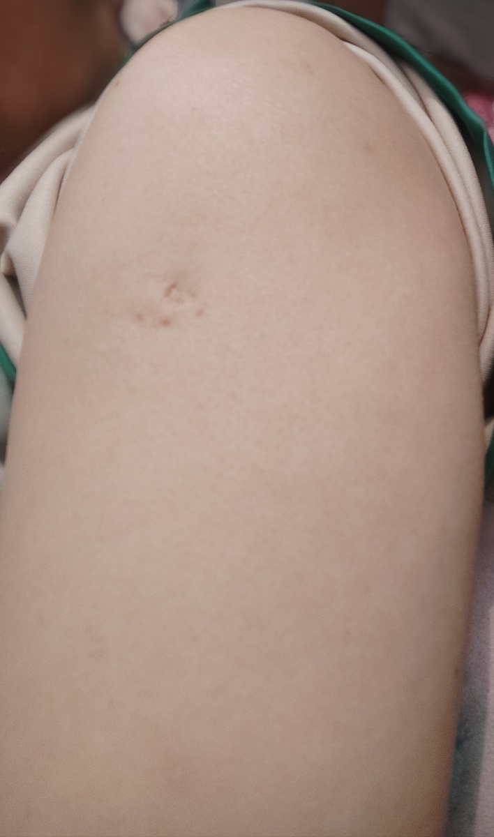 有疫苗图片打完新冠疫苗起红点图手臂疫苗疤痕儿童打了新冠疫苗起红点