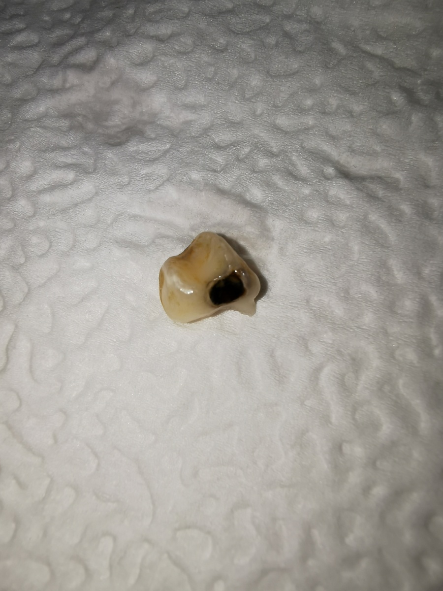 一颗坏掉的小牙要保护好牙齿奥