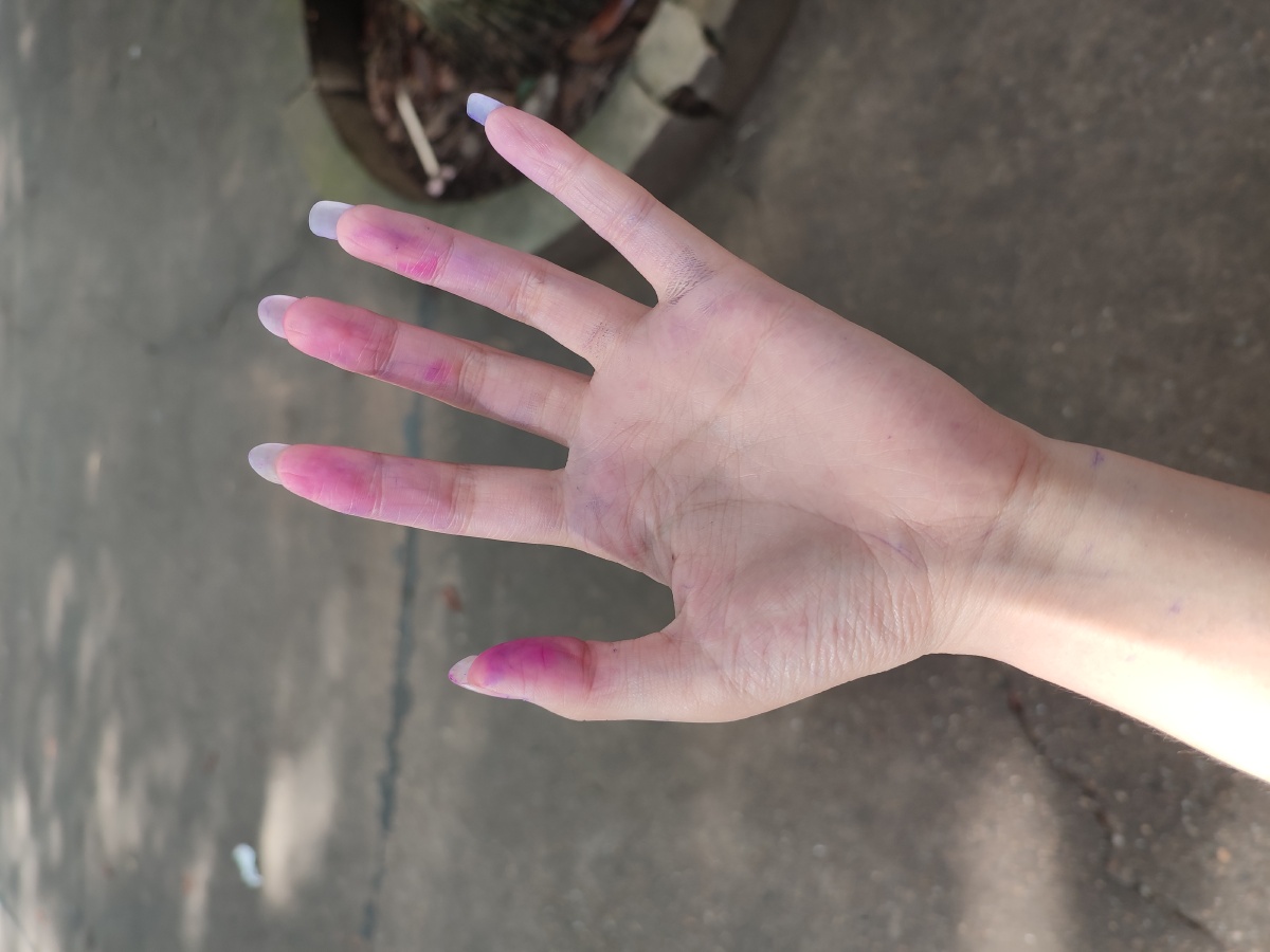 被龙胆紫染色的手