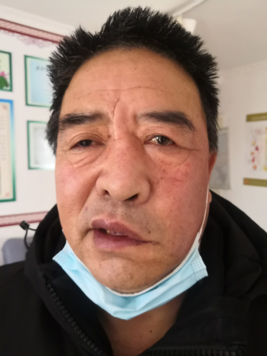 面瘫患者1