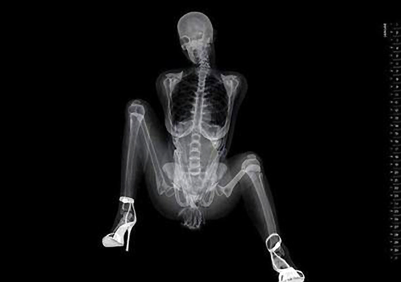 x-ray_picture_6 br />