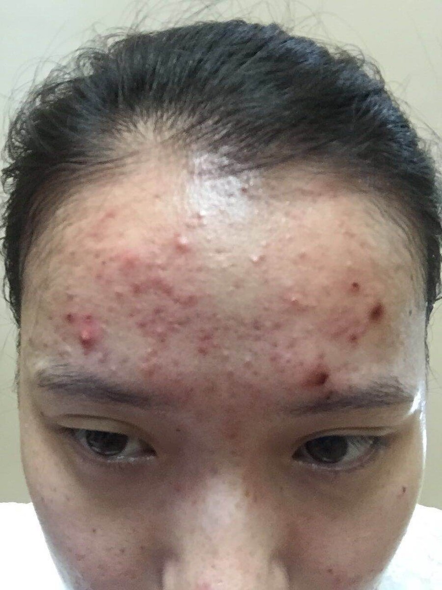 脸部皮肤过敏起红疹子用什么药?