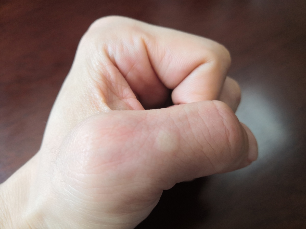 被蚊子咬了蚊子叮咬蚊子叮个包