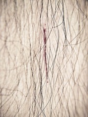 the scar