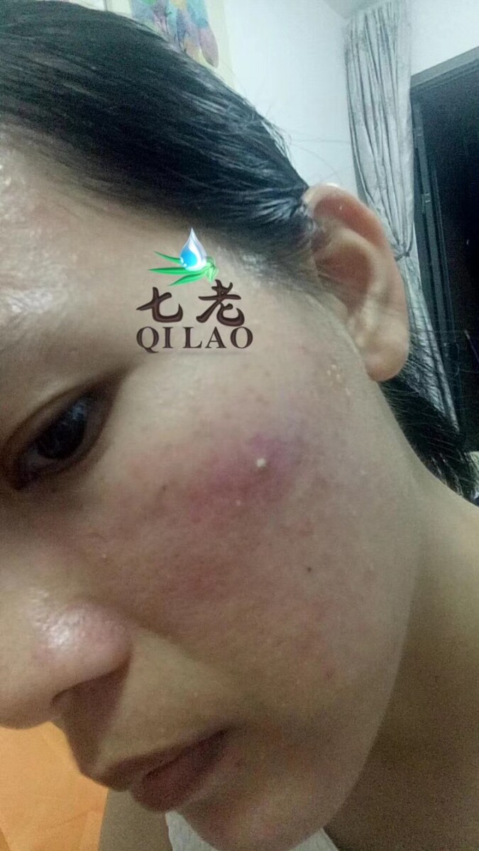 西安国际医学中心皮肤科:脸上长痘痘该吃什么?
