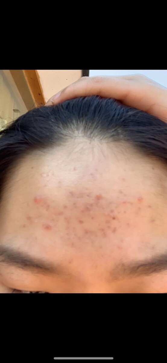 为什么头皮会痒?头皮瘙痒是什么原因引起的 为什么头皮会痒?头皮瘙痒是什么原因引起的