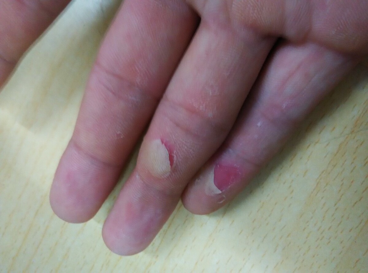 手指甲没有月牙是什么原因造成的?