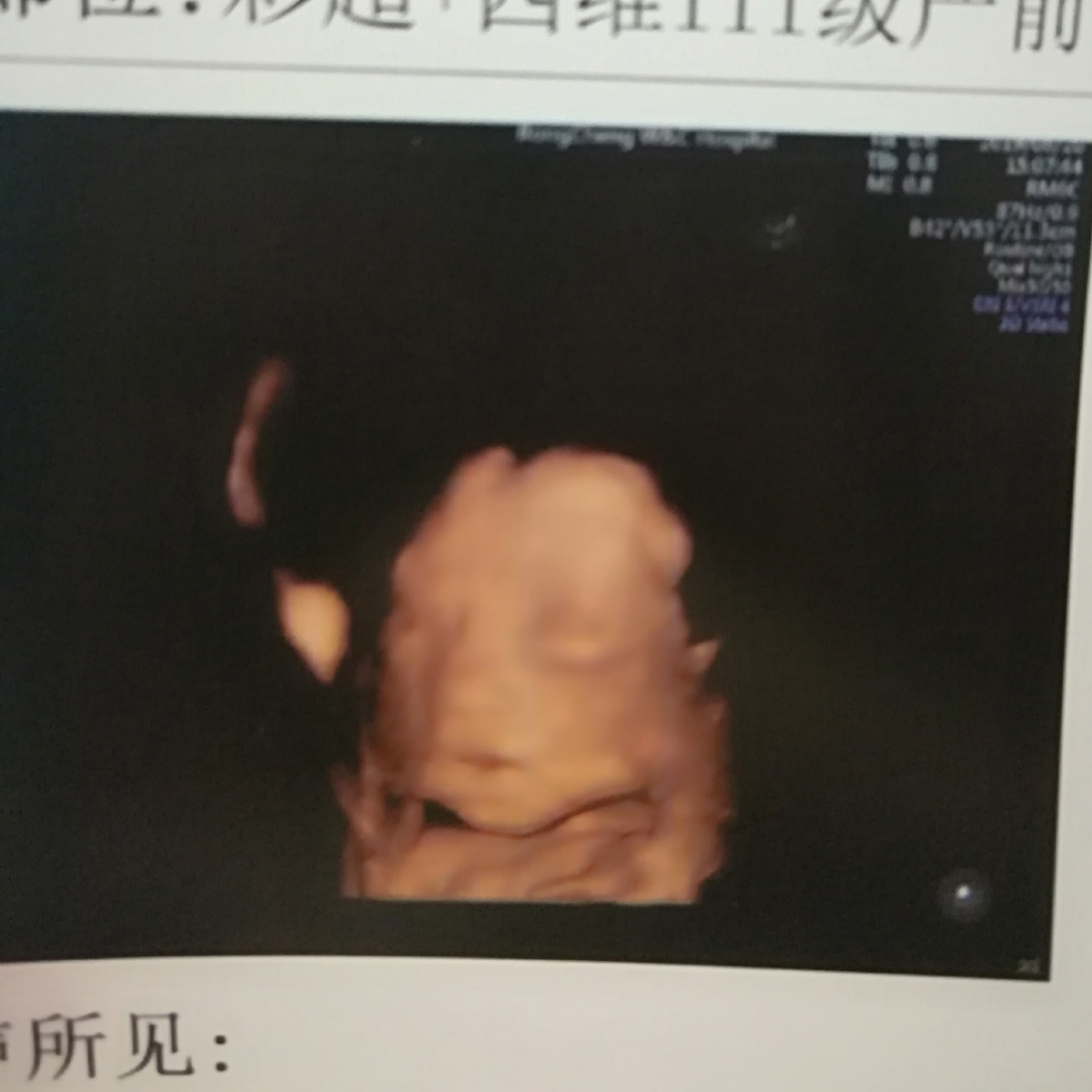 两次唇腭裂需要检查